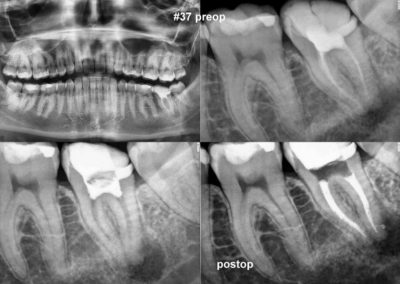 Powtórne leczenie kanałowe pod mikroskopem zęba 37