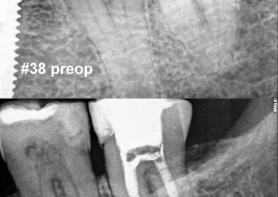 Leczenie kanałowe pod mikroskopem zęba 38