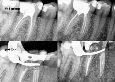 Leczenie kanałowe pod mikroskopem zęba 46