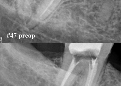 Powtórne leczenie kanałowe pod mikroskopem zęba 47