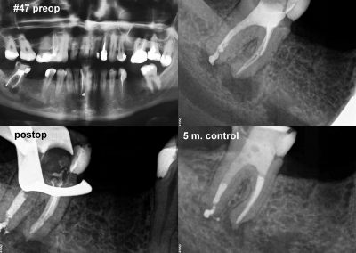 Powtórne leczenie kanałowe zęba 47