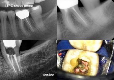 Leczenie kanałowe pod mikroskopem zęba 37