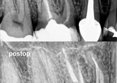 Powtórne leczenie kanałowe zęba 16