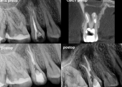 Leczenie kanałowe pod mikroskopem - ząb 15
