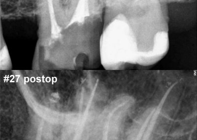Leczenie kanałowe pod mikroskopem zęba 27