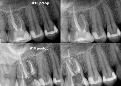 Powtórne leczenie kanałowe pod mikroskopem zęba 16