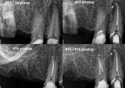 Leczenie kanałowe pod mikroskopem zębów 13 i 14