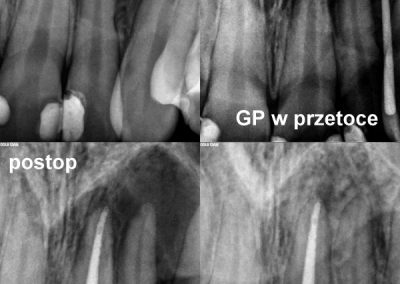 Leczenie kanałowe pod mikroskopem zęba 21 z bardzo dużą zmianą zapalną