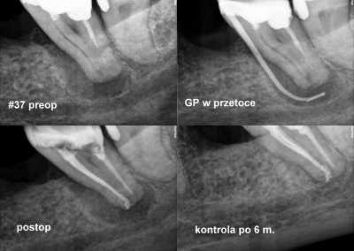 Ponowne leczenie kanałowe pod mikroskopem zęba 37 z przetoką i dużą zmianą zapalną