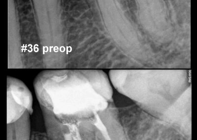 Leczenie kanałowe pod mikroskopem zęba 36