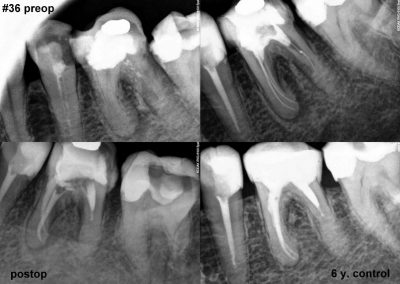 Leczenie kanałowe pod mikroskopem zęba 36
