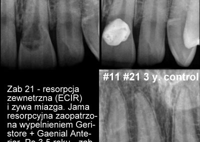 Resorpcja przyszyjkowa - leczenie pod mikroskopem