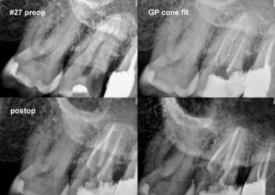 Leczenie kanałowe pod mikroskopem zęba 27