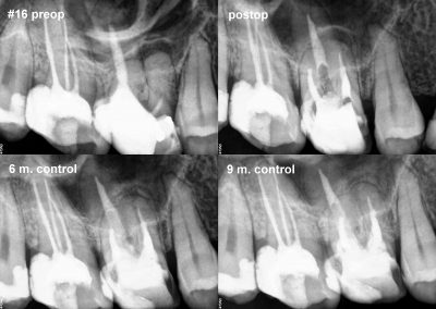 Powtórne leczenie kanałowe pod mikroskopem zęba 16