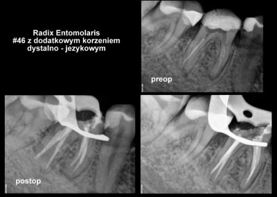 Leczenie kanałowe pod mikroskopem zęba 46