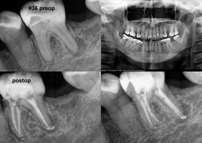 Leczenie kanałowe pod mikroskopem - ząb 36