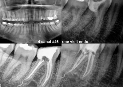 Leczenie kanałowe pod mikroskopem zęba 46
