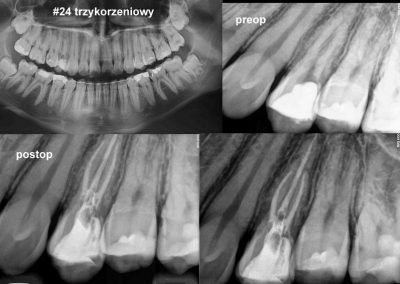Leczenie kanałowe pod mikroskopem zęba 24