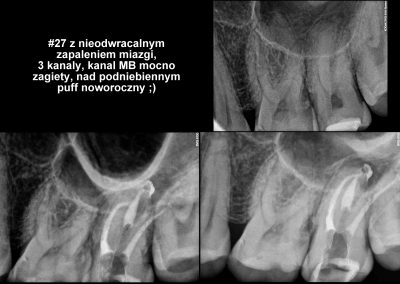 Leczenie kanałowe pod mikroskopem zęba 27