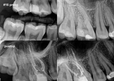 Leczenie kanałowe pod mikroskopem zęba 16