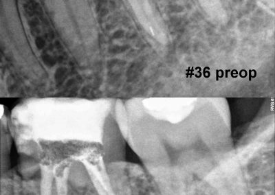 Leczenie kanałowe pod mikroskopem zęba 36