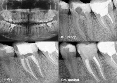 Leczenie kanałowe pod mikroskopem zęba #36