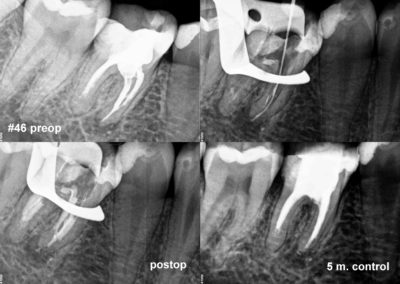Powtórne leczenie kanałowe pod mikroskopem zęba #46
