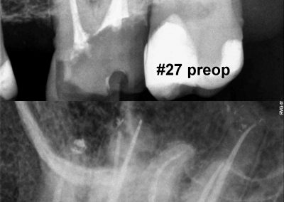 Leczenie kanałowe pod mikroskopem zęba 27
