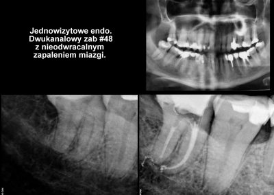 Leczenie kanałowe pod mikroskopem - ząb 48