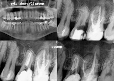 Leczenie kanałowe pod mikroskopem zęba 25