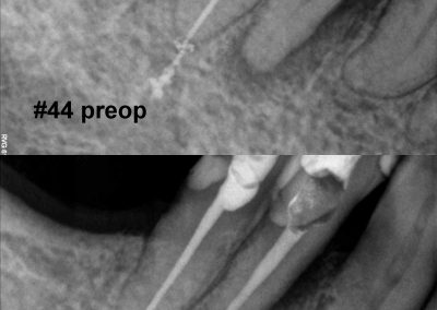 Leczenie kanałowe pod mikroskopem zęba 44