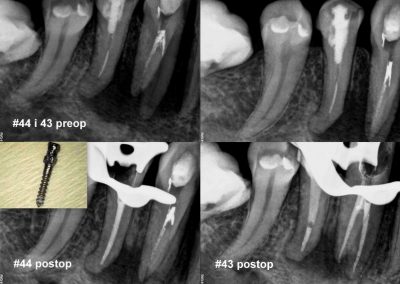 Leczenie kanałowe pod mikroskopem zębów 44 i 43