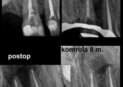 Leczenie kanałowe pod mikroskopem zęba 21