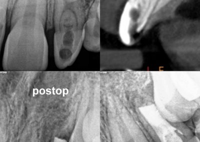 Leczenie kanałowe pod mikroskopem zęba 22 - dens invaginatus