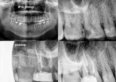 Leczenie kanałowe zęba 16