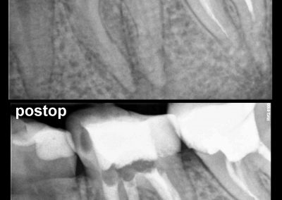 Leczenie kanałowe pod mikroskopem - ząb 36