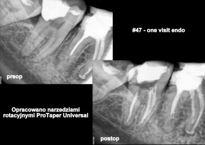 Leczenie kanałowe pod mikroskopem zęba 47