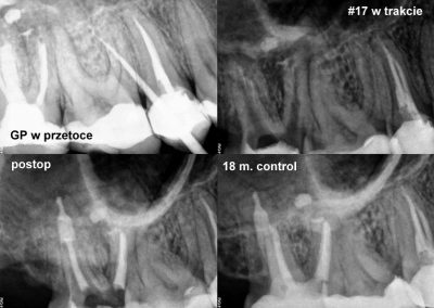 Powtórne leczenie kanałowe pod mikroskopem zęba 17
