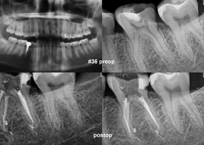 Leczenie kanałowe pod mikroskopem zęba 36