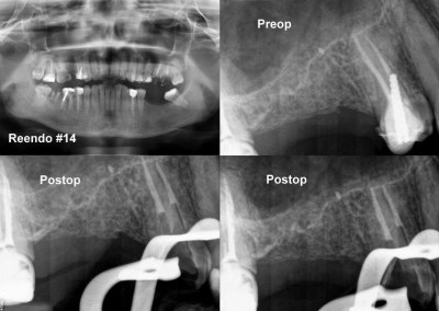 Powtórne leczenie kanałowe pod mikroskopem zęba 14