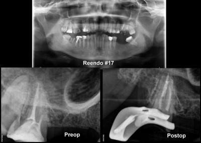 Powtórne leczenie kanałowe pod mikroskopem zęba 17