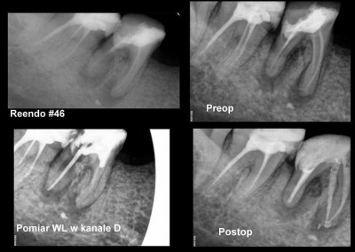 Powtórne leczenie kanałowe pod mikroskopem zęba 46