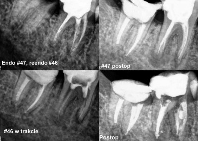 Leczenie kanałowe zębów 46 i 47