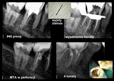 Wyjęcie złamanego narzędzia i zamknięcie perforacji cementem MTA