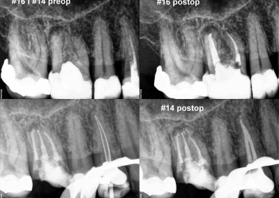 Leczenie kanałowe pod mikroskopem zębów 16 i 14
