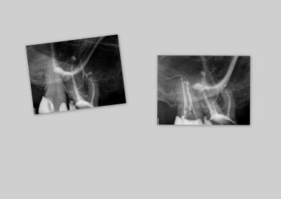 Leczenie kanałowe pod mikroskopem - ząb 17 dwukanałowy