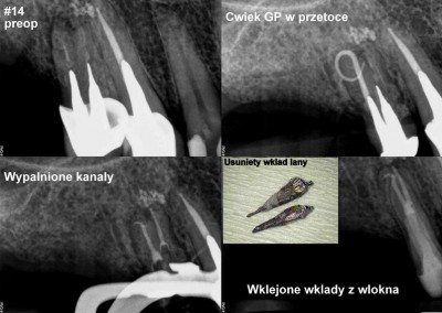 Usunięcie podwójnego wkładu lanego z korzenia