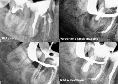 Leczenie kanałowe pod mikroskopem zęba 47 z resorpcją wewnętrzną
