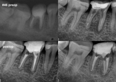 Leczenie kanałowe pod mikroskopem zęba 46