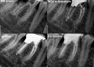 Leczenie kanałowe pod mikroskopem zęba 46 z dużą zmianą zapalną